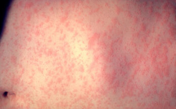 Symbolbild. Foto: CDC/Dr. Heinz F. Eichenwald