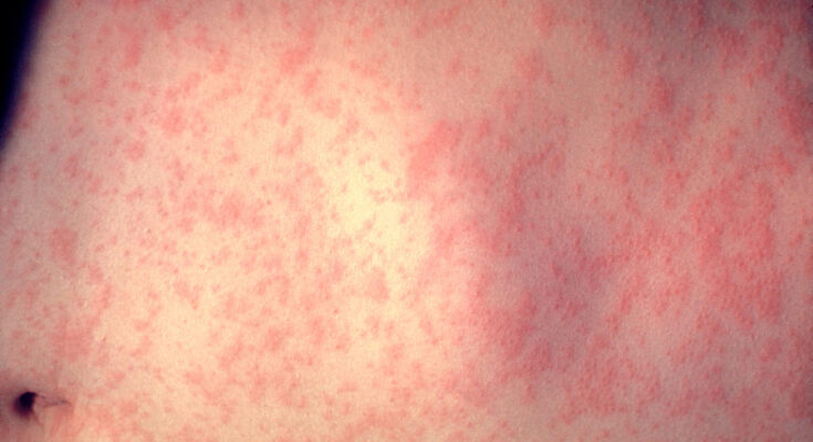 Symbolbild. Foto: CDC/Dr. Heinz F. Eichenwald